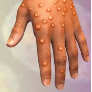 disease monkeypox